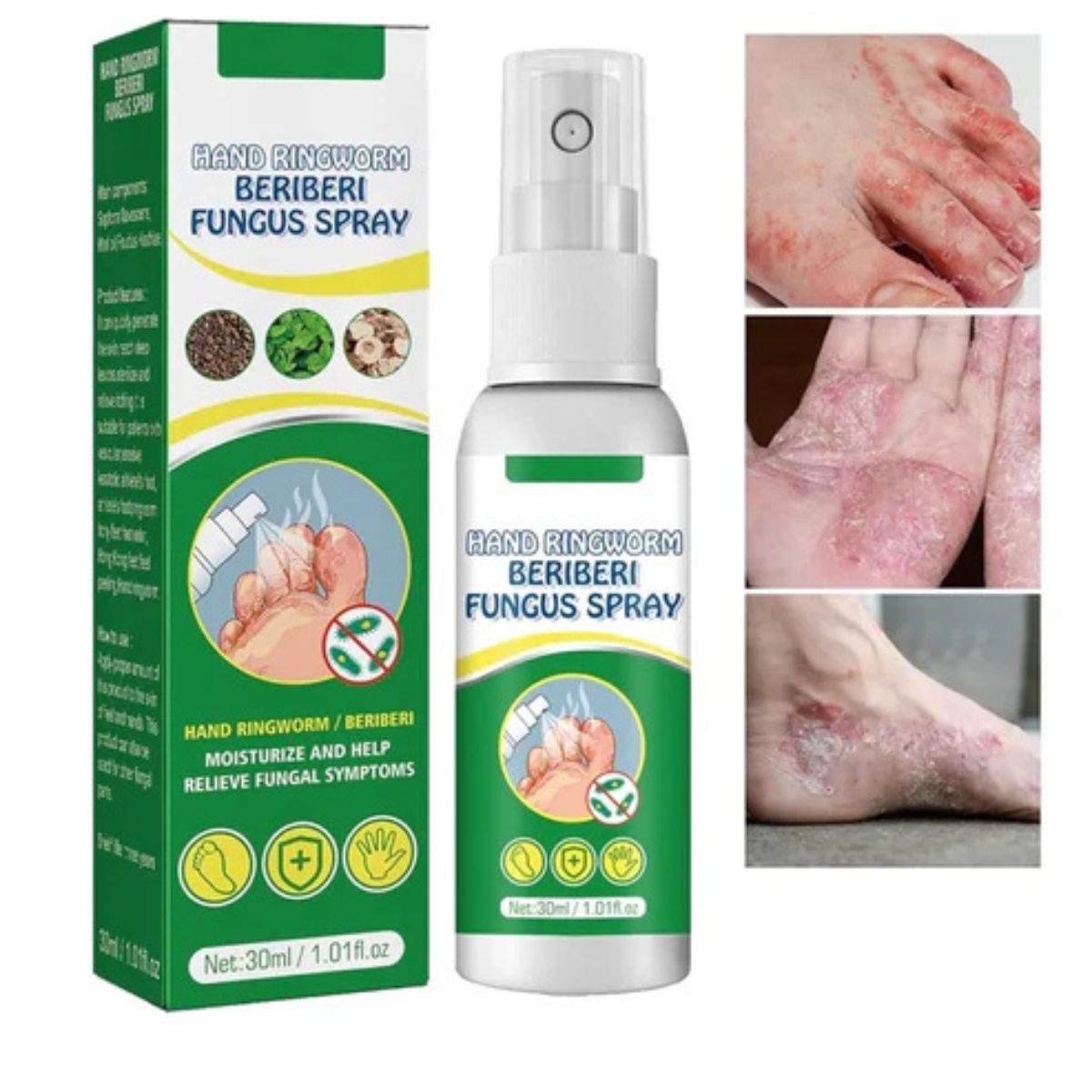 Hand Ringworm Beriberi Fungus Spray (Original) – 30ml