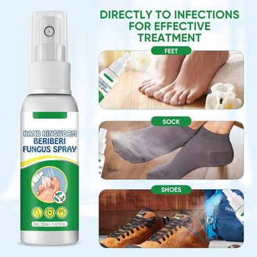Hand Ringworm Beriberi Fungus Spray (Original) – 30ml