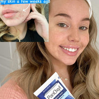 PanOxyl Acne Creamy Wash 4% Benzoyl Peroxide (170g) – Gentle Daily Acne Cleanser